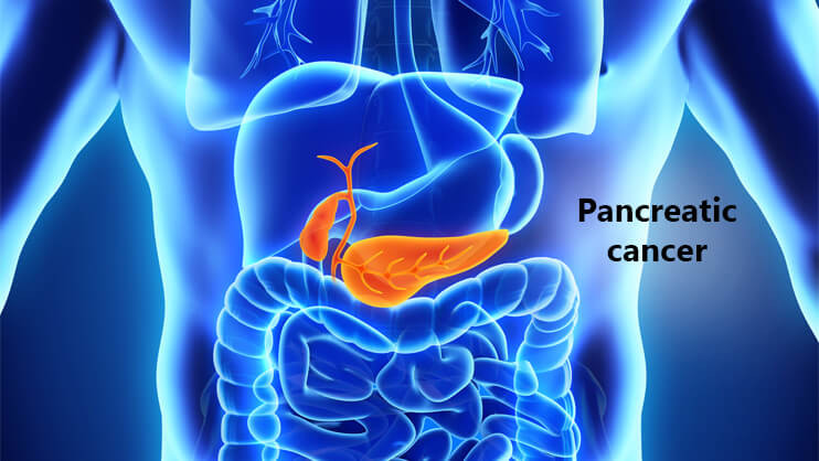 10 Signs of Pancreatic Cancer